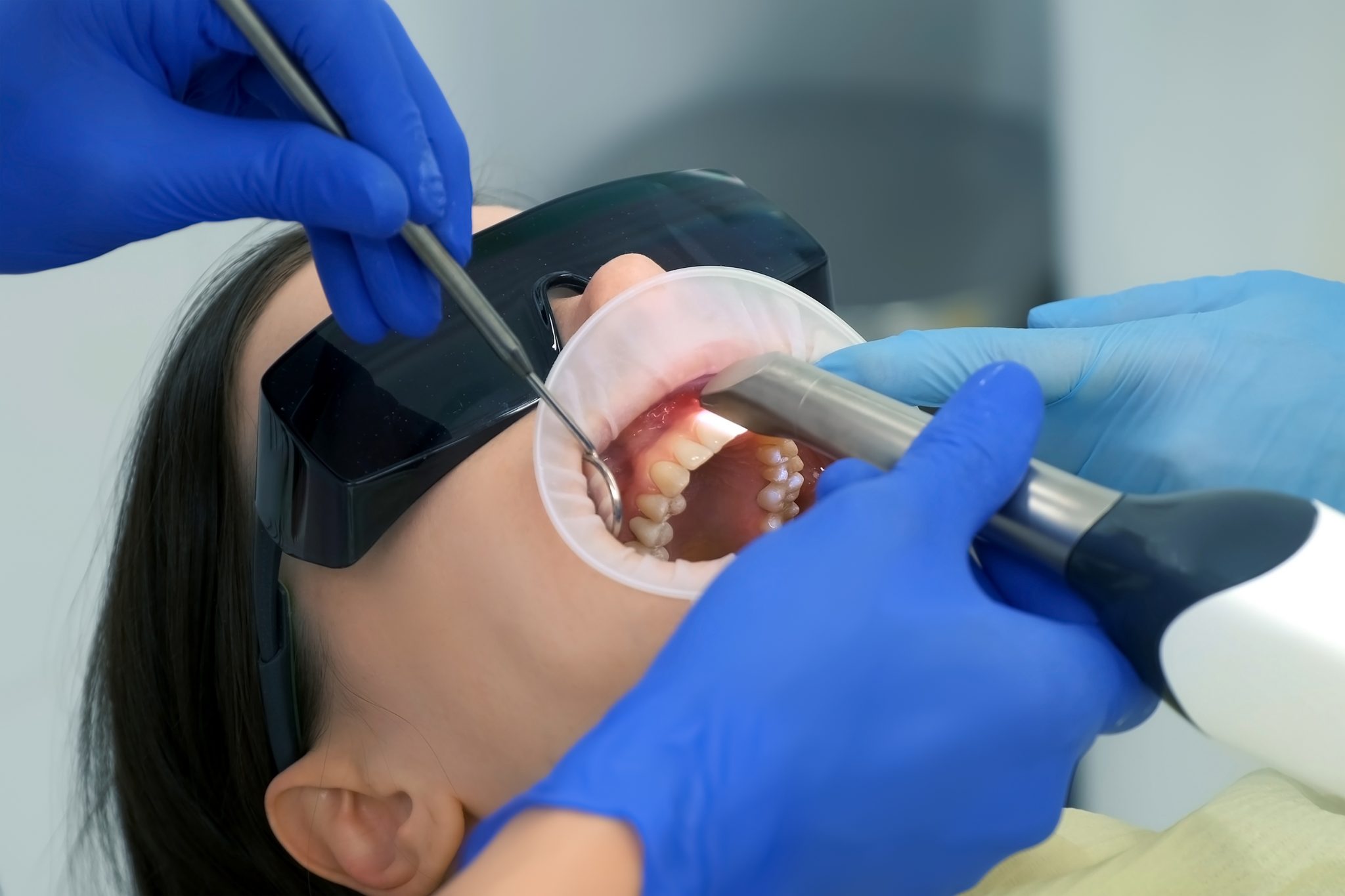 How Are Teeth Prepped for Veneers