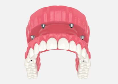 All-on-Four Dental Implants