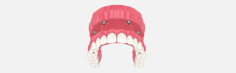 All-on-Four Dental Implants