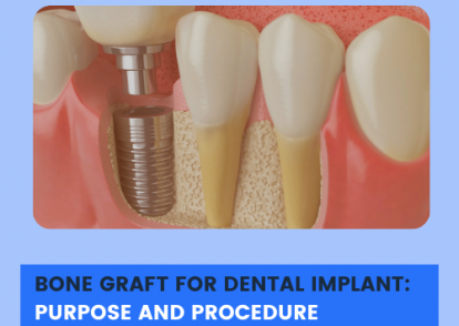 Bone Graft for Dental Implant: