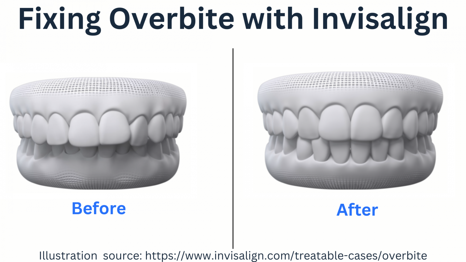 Can Invisalign Fix Overbite How it Works and Timeline