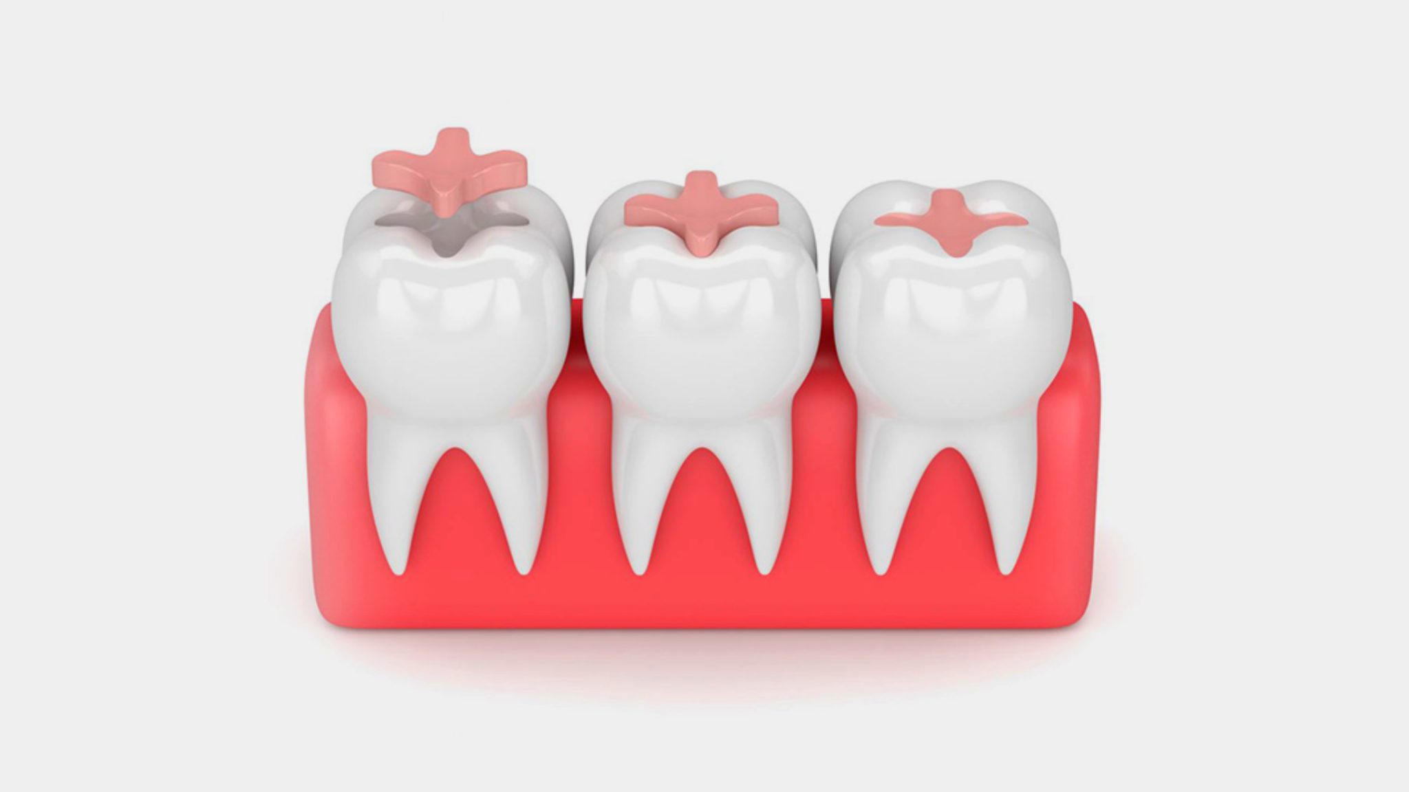 Types of Dental Fillings All You Need to Know