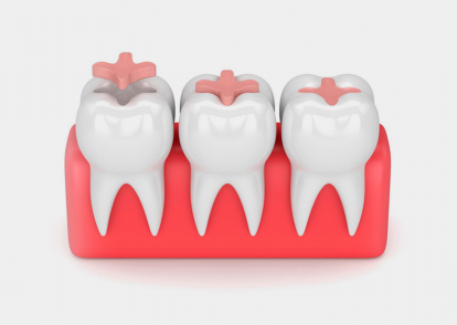 types of dental fillings