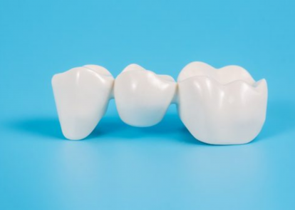 Dental Bridges: How Long They Last and How to Maintain Them