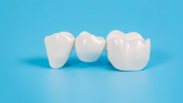 Dental Bridges: How Long They Last and How to Maintain Them