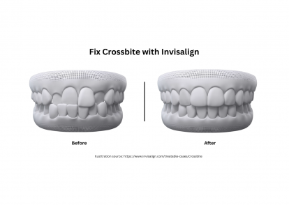 Can Invisalign Fix Crossbite? Let’s Examine the possibilities